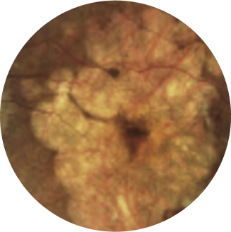 Colour fundus photography